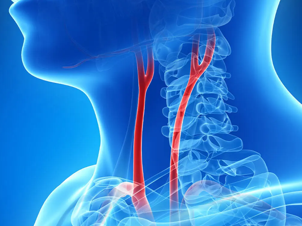 Ankara Şah Damarı (Karotis) Hastalıkları